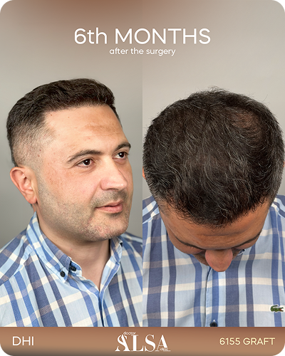 Saç Ekimi Sonuç